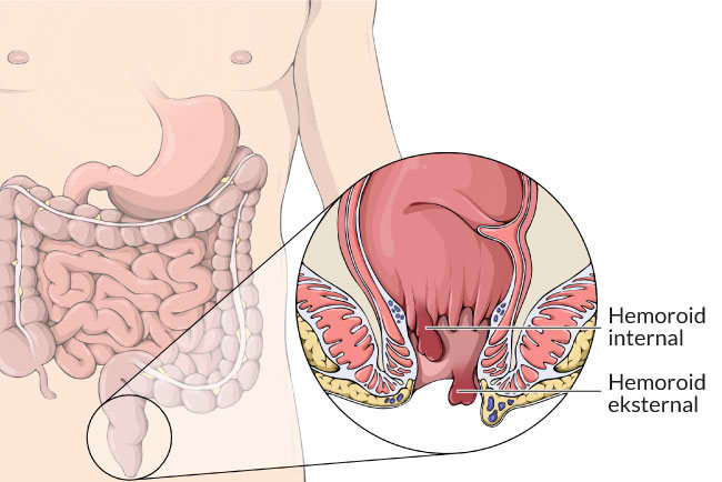 cara mengobati ambeien, cara mengobati wasir, obat wasir, obat ambeien, cara menghilangkan ambeien,obat ambeien