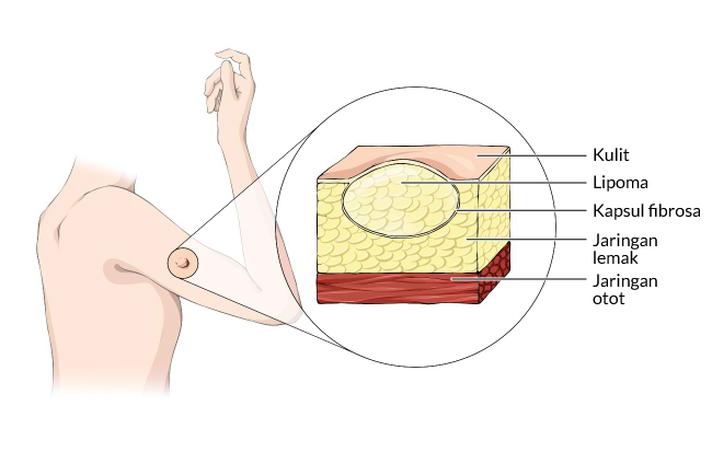 obat kanker, obat kanker payudara, obat kanker rahim, obat kanker darah, obat Benjolan, Obat Tumor,