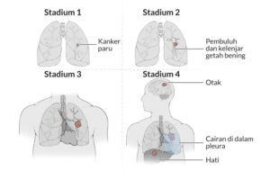 obat kanker, obat kanker payudara, obat kanker rahim, obat kanker darah, obat Benjolan, Obat Tumor,