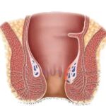 obat ambeie,obat ambeien ampuh,ambefree