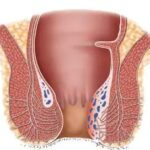 obat ambeie,obat ambeien ampuh,ambefree