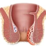 obat ambeie,obat ambeien ampuh,ambefree